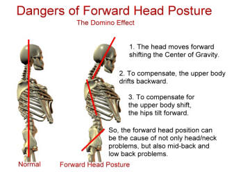 Forward-Head-Posture2